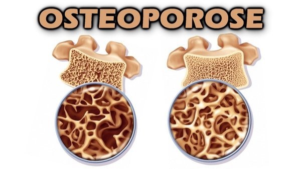 Entenda O Que é Osteoporose, Suas Causas E Como Se Prevenir