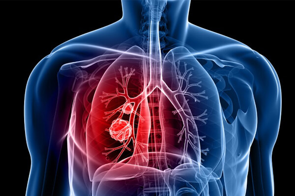 Pneumonia: Sintomas, Fatores De Risco E Como Tratar