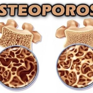 Entenda O Que é Osteoporose, Suas Causas E Como Se Prevenir