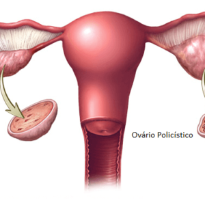 Síndrome Do Ovário Policístico: Sintomas, Tratamentos E Prevenção