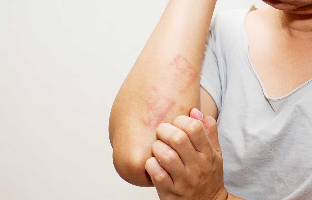Dermatite: O Que é? Causas, Sintomas E Como Prevenir