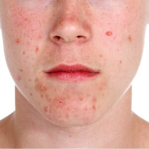 Acne: O Que é, Sintomas, Causas, Fatores De Risco E Prevenção