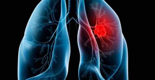 Embolia Pulmonar: Você Sabe O Que é?