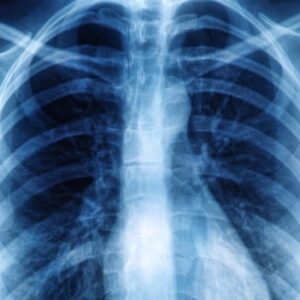 Fibrose Pulmonar: O Que é? Causas E Sintomas