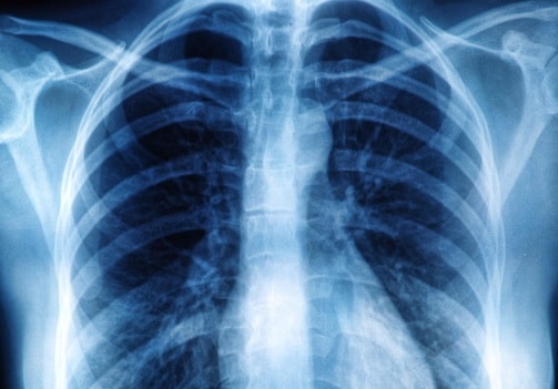 Fibrose Pulmonar: O Que é? Causas E Sintomas